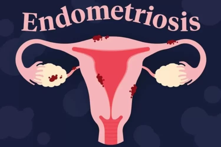 Mengenal Penyakit Endometriosis